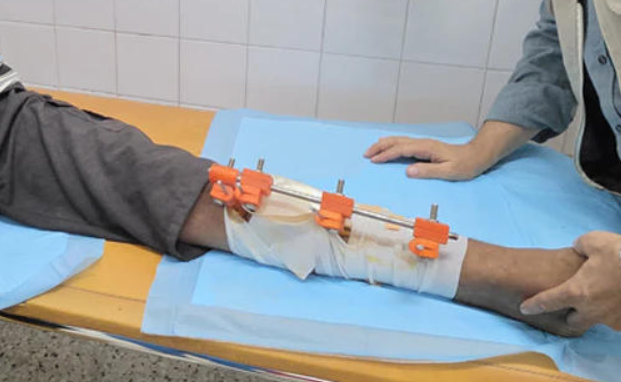 加沙医生在资源匮乏地带利用3D打印造出“救命”外固定器 image 加沙医生在资源匮乏地带利用3D打印造出“救命”外固定器 image