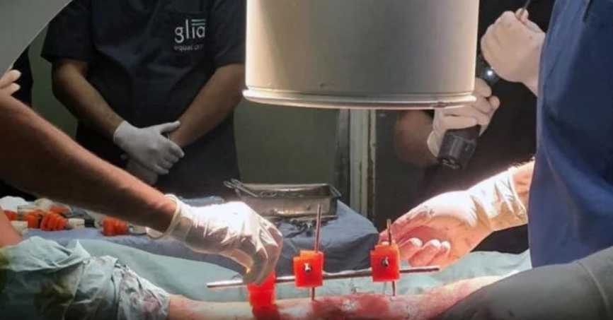 加沙医生在资源匮乏地带利用3D打印造出“救命”外固定器 image 加沙医生在资源匮乏地带利用3D打印造出“救命”外固定器 image