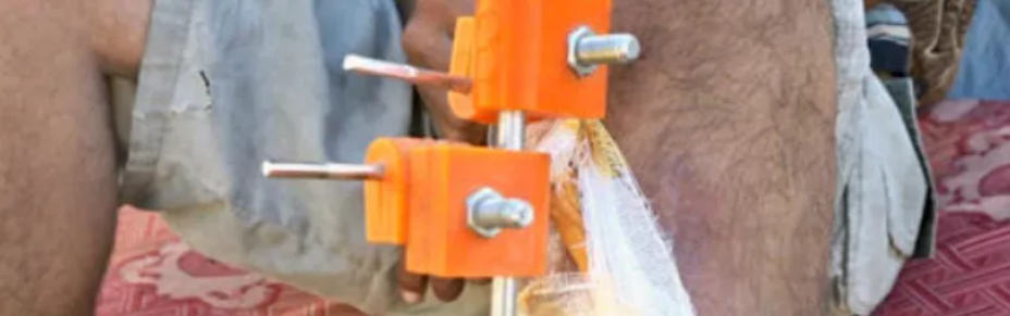 加沙医生在资源匮乏地带利用3D打印造出“救命”外固定器 image 加沙医生在资源匮乏地带利用3D打印造出“救命”外固定器 image