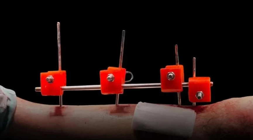 加沙医生在资源匮乏地带利用3D打印造出“救命”外固定器 image 加沙医生在资源匮乏地带利用3D打印造出“救命”外固定器 image