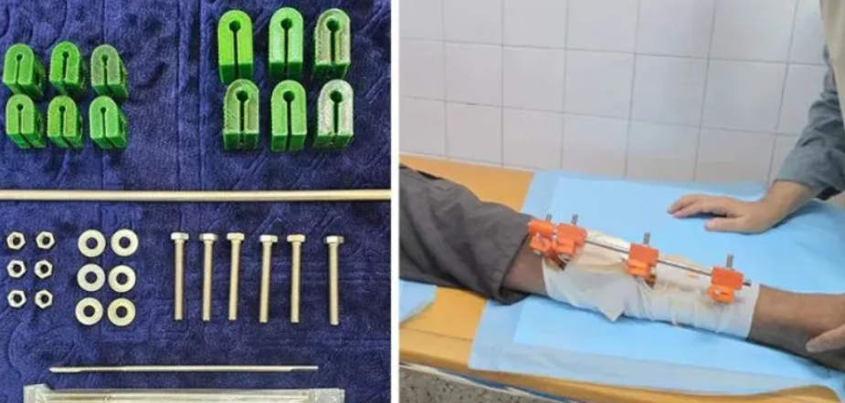 加沙医生在资源匮乏地带利用3D打印造出“救命”外固定器 image 加沙医生在资源匮乏地带利用3D打印造出“救命”外固定器 image