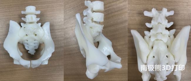 3D打印技术助力脊柱手术，让患者重获新生